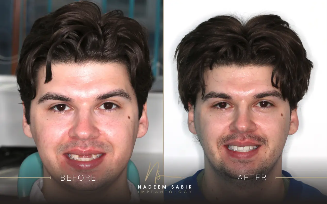 before and after photo of dental implant treatment patient