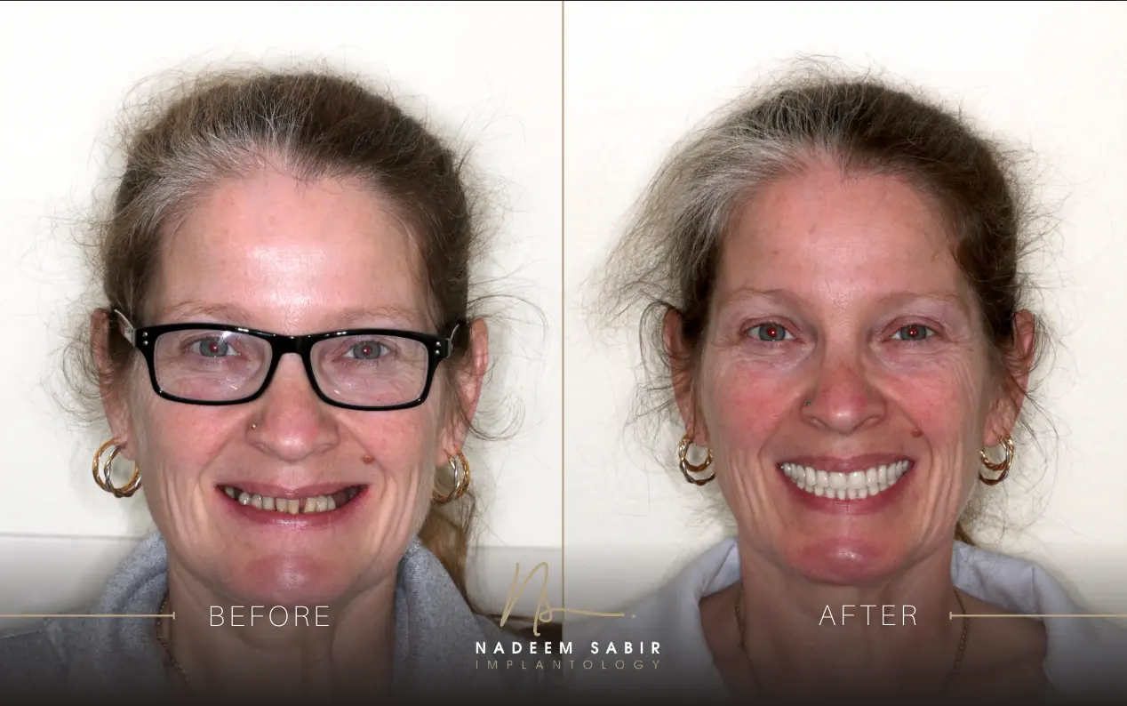 before and after photo of dental implant treatment patient