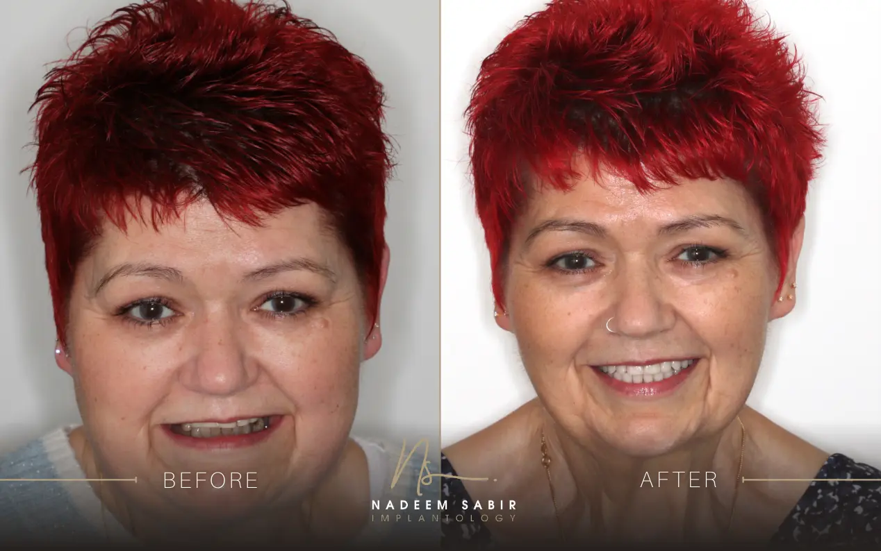 before and after photo of dental implant treatment patient