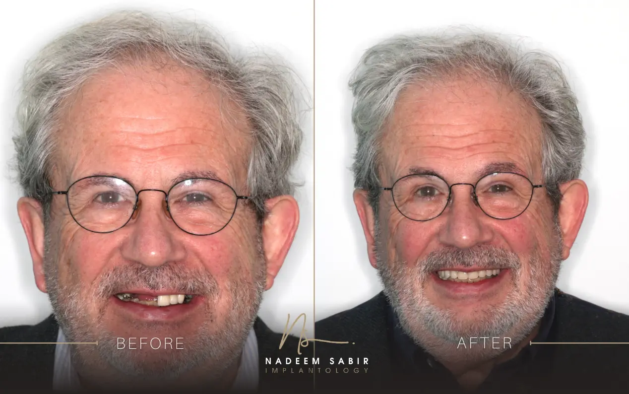 before and after photo of dental implant treatment patient