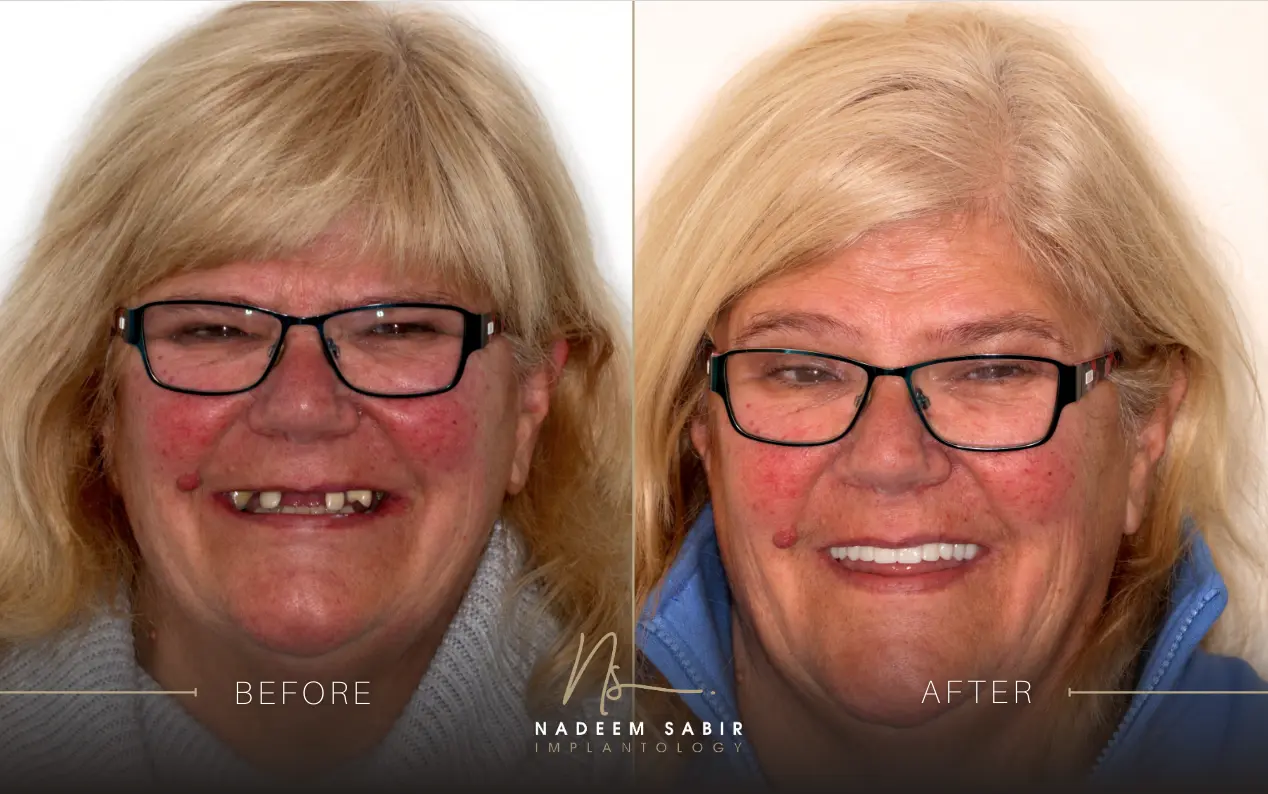 before and after photo of dental implant treatment patient