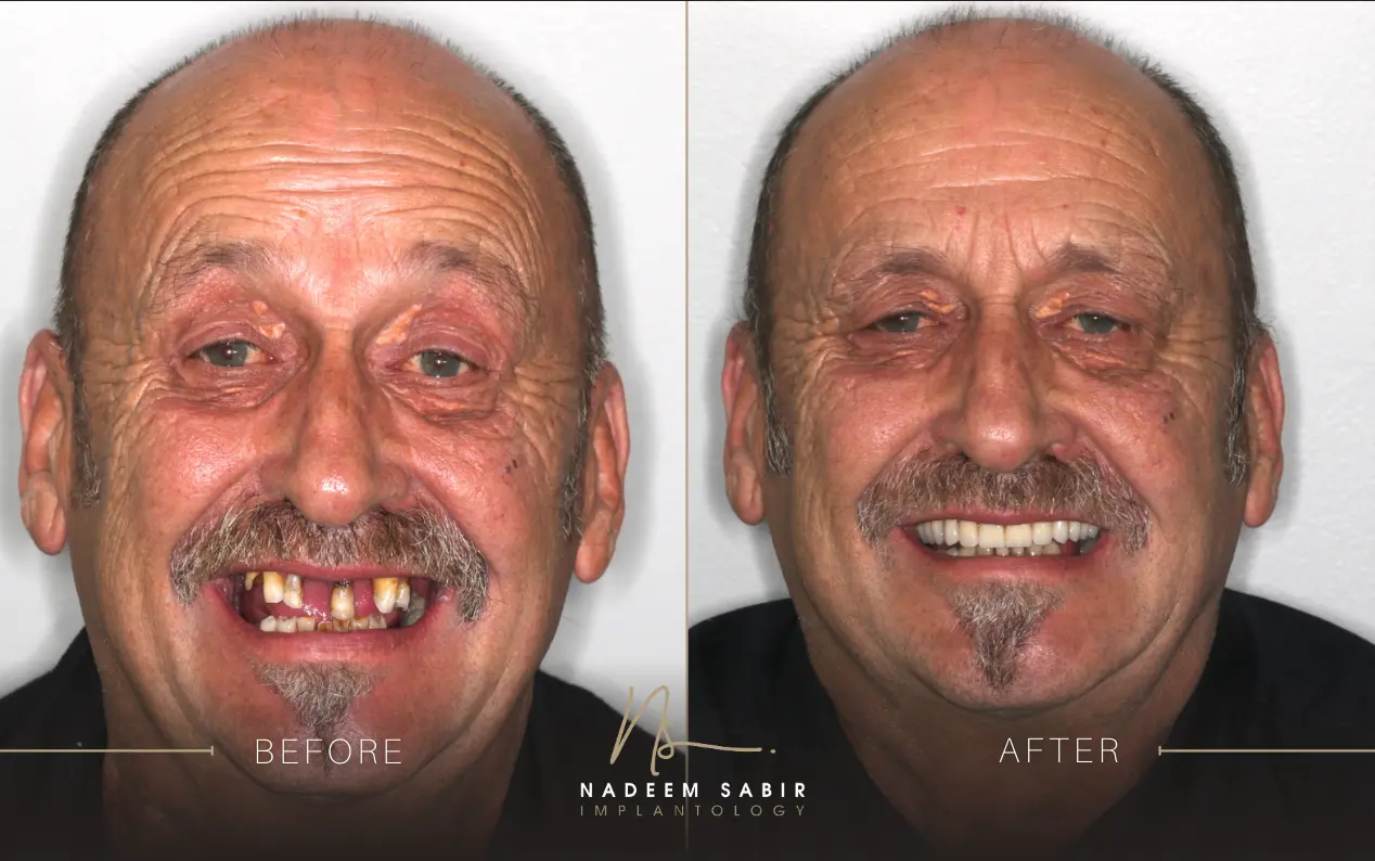 before and after photo of dental implant treatment patient