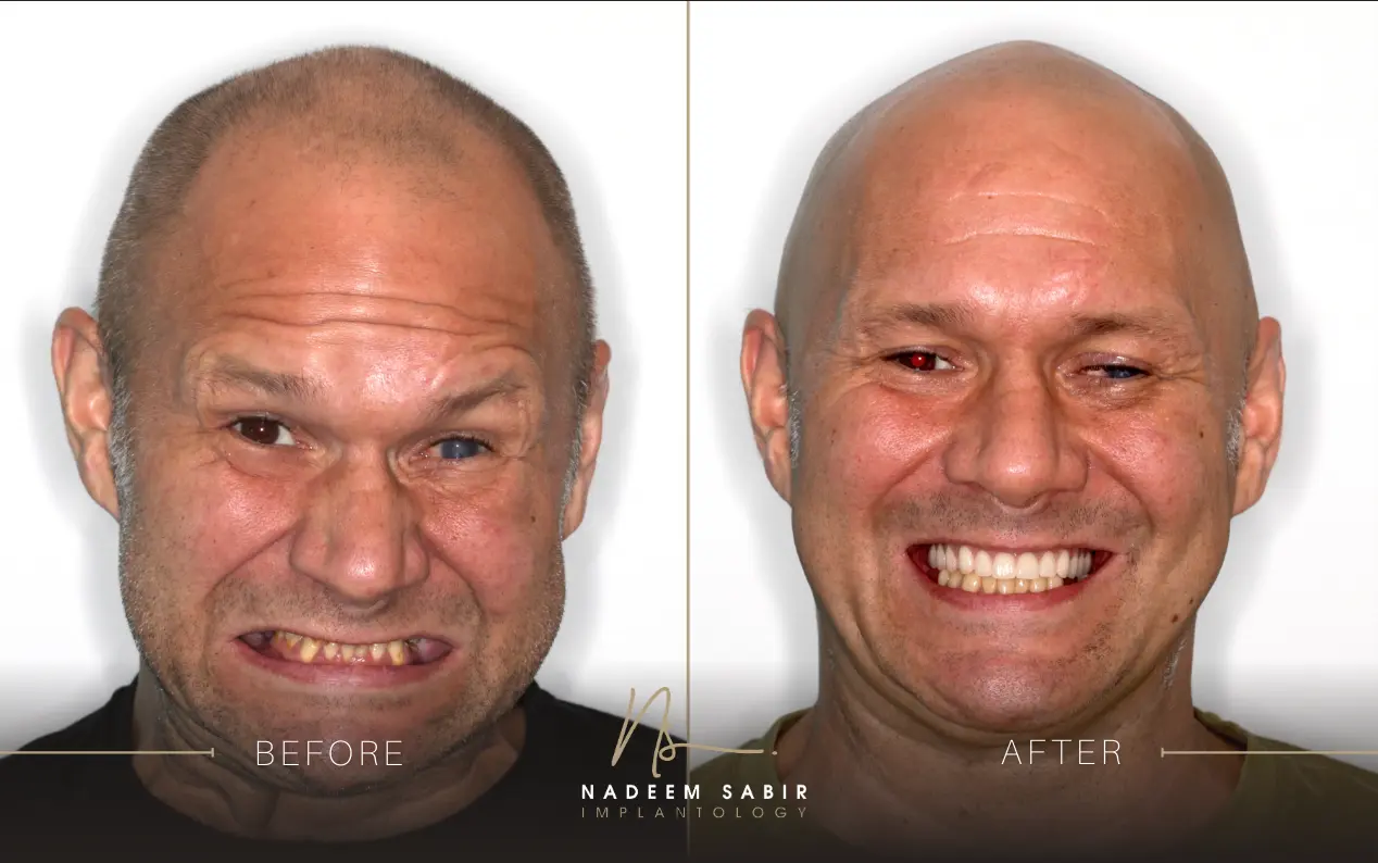 before and after photo of dental implant treatment patient