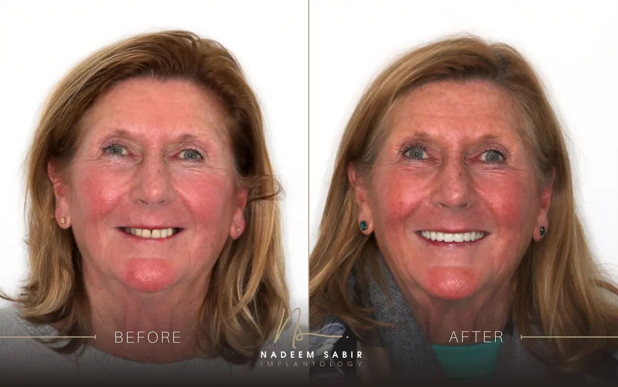 before and after photo of dental implant treatment patient