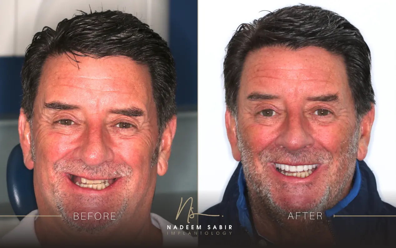 before and after photo of dental implant treatment patient