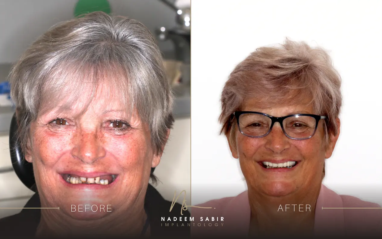 before and after photo of dental implant treatment patient