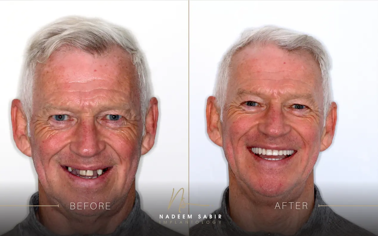 before and after photo of dental implant treatment patient
