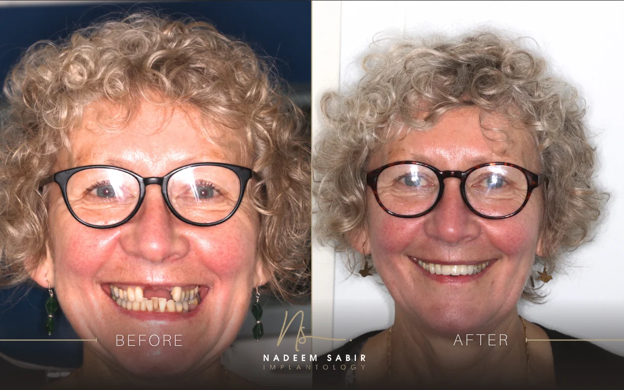 before and after photo of dental implant treatment patient