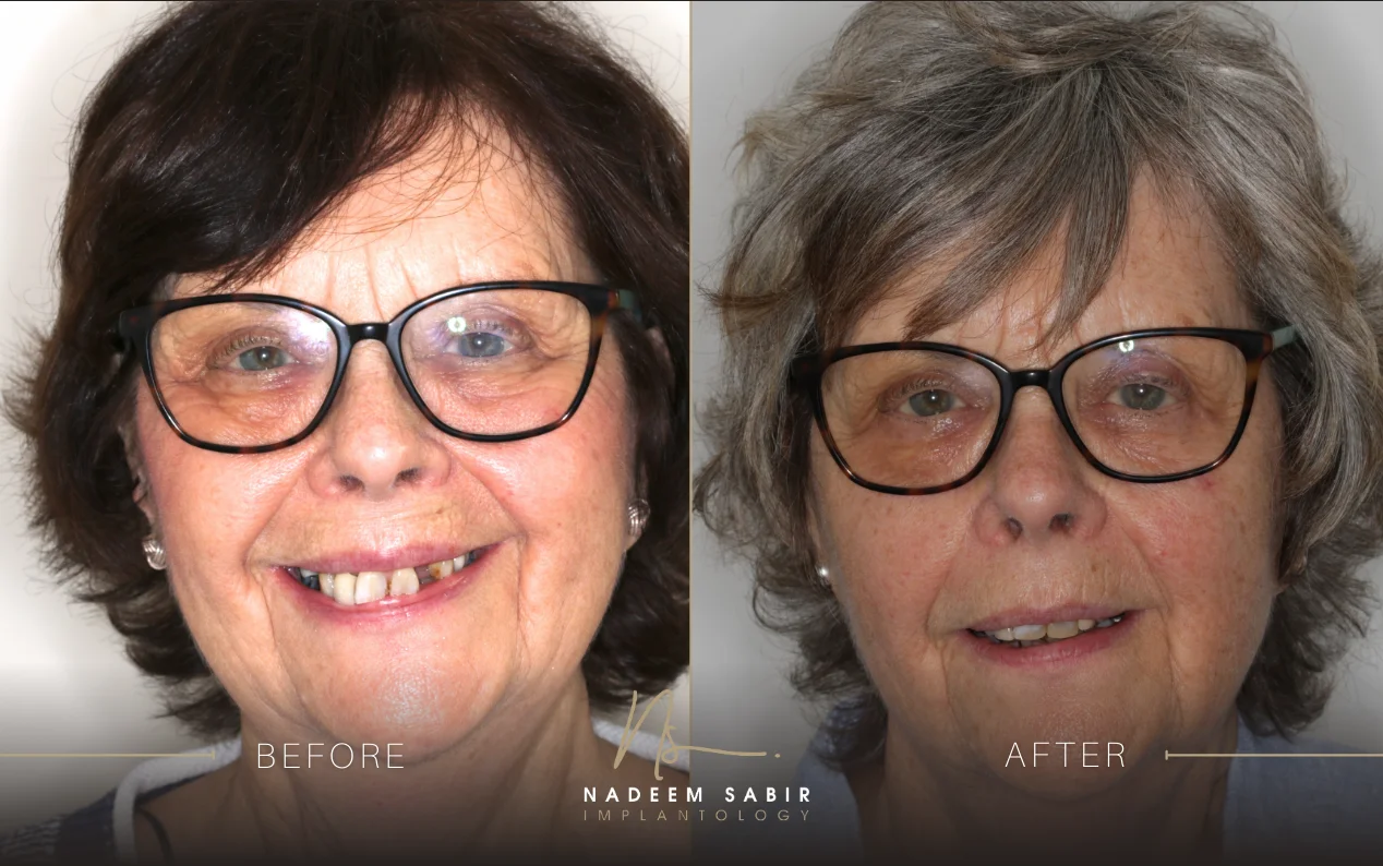before and after photo of dental implant treatment patient
