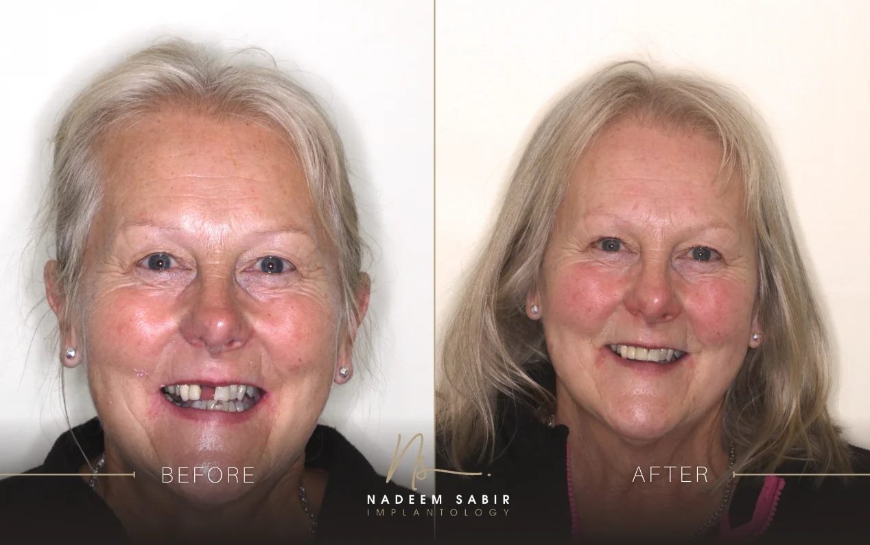 before and after photo of dental implant treatment patient