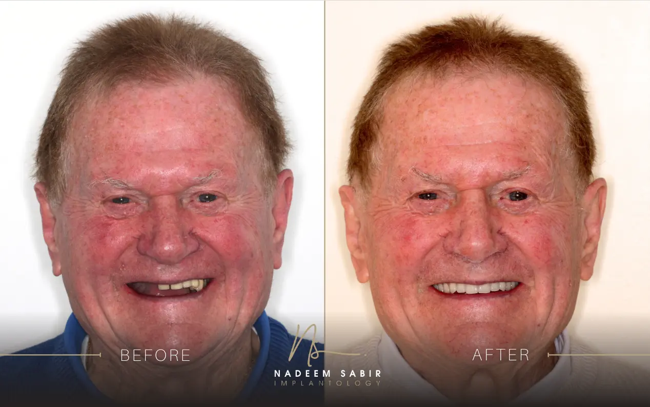 before and after photo of dental implant treatment patient