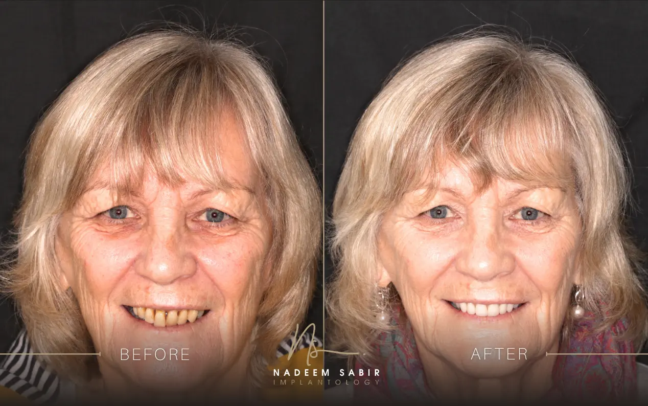 before and after photo of dental implant treatment patient