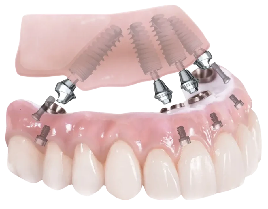 cross section of jaw showing dental implant placement